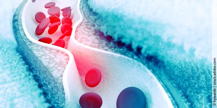 Erhöhte Cholesterinwerte bei Hashimoto: Was steckt dahinter und wie du langfristig deinen Cholesterinspiegel senken kannst